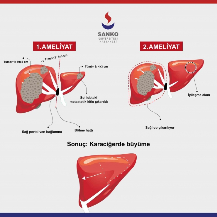 Güney Kore’den Şifa İçin Sanko Üniversitesi Hastanesi’ne Geldi