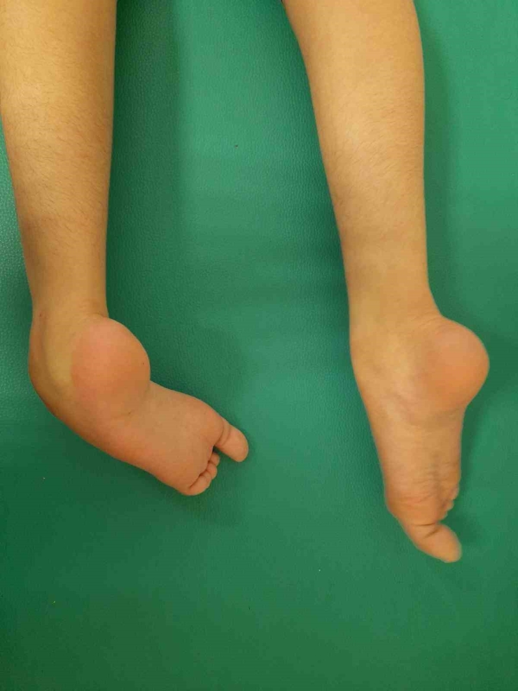 Şanlıurfa’da Yatağa Bağlı Kardeşler Tedavi Sonrası Yürümeye Başladı